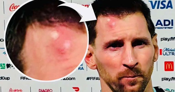 Messi sưng vêu trán sau trận thắng Cabo Verde: Vì sao nên nỗi? - hình ảnh - j88slot.vip Messi sưng vêu trán sau trận thắng Cabo Verde: Vì sao nên nỗi? - hình ảnh - j88slot.vip